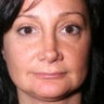 Revision Rhinoplasty