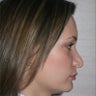 Revision Rhinoplasty