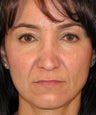 Revision Rhinoplasty