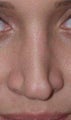 Revision Rhinoplasty