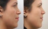 Revision Rhinoplasty