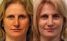 Open revision Rhinoplasty with auricular grafting