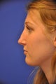 Revision Rhinoplasty