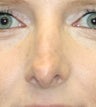 Revision Rhinoplasty