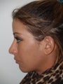 Revision Rhinoplasty