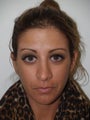 Revision Rhinoplasty