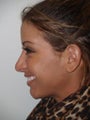 Revision Rhinoplasty