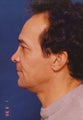 Revision Rhinoplasty