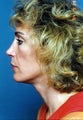 Revision Rhinoplasty
