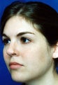 Revision Rhinoplasty