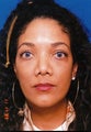 Revision Rhinoplasty
