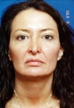 Revision Rhinoplasty