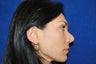 Revision Rhinoplasty