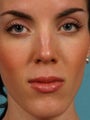 Revision Rhinoplasty