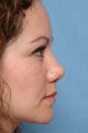 Revision Rhinoplasty