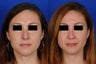 Revision Rhinoplasty