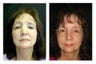 Rhinoplasty Revision