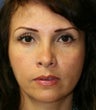 Revision tip rhinoplasty