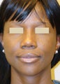 African American Rhinoplasty