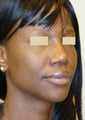 African American Rhinoplasty