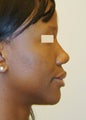 African-American Rhinoplasty