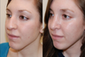 Rhinoplasty