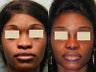 African American Rhinoplasty