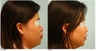 Dallas Asian Rhinoplasty