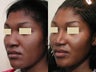 African American Rhinoplasty