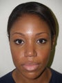 Primary rhinoplasty