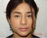 Rhinoplasty
