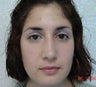 Rhinoplasty
