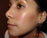 Rhinoplasty