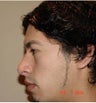 Rhinoplasty