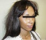 Rhinoplasty