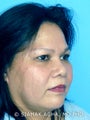 Rhinoplasty