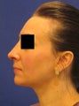 Rhinoplasty