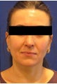 Rhinoplasty