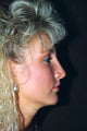 Rhinoplasty (nose job)