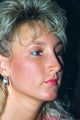 Rhinoplasty (nose job)