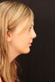 Rhinoplasty with chin augmentation