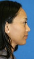 rhinoplasty