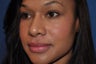 33 year-old female Rhinoplasty