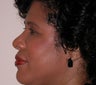 Rhinoplasty