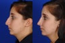Open Rhinoplasty