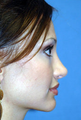 Rhinoplasty