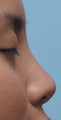 Non Surgical Rhinoplasty