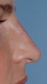 Non Surgical Rhinoplasty
