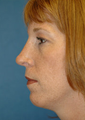 Rhinoplasty