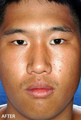Rhinoplasty